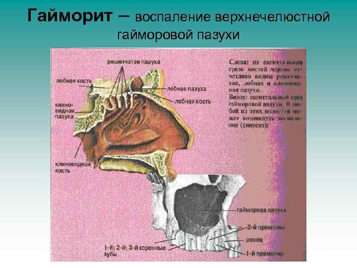 Гайморит – воспаление верхнечелюстной гайморовой пазухи 
