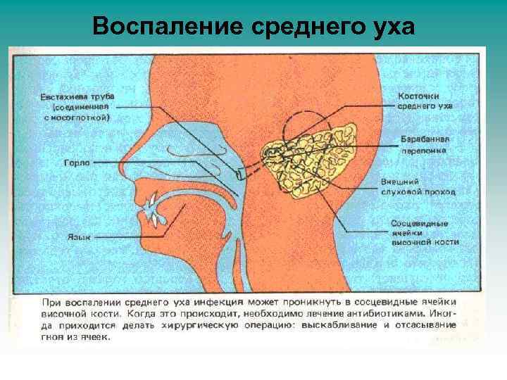 Воспаление среднего уха 