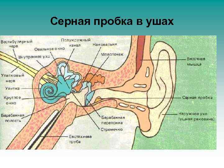 Серная пробка в ушах 