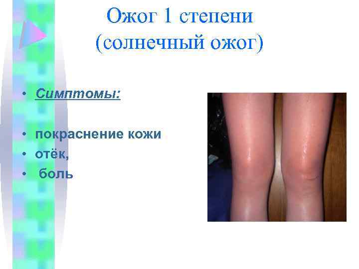 Ожог 1 степени (солнечный ожог) • Симптомы: • покраснение кожи • отёк, • боль