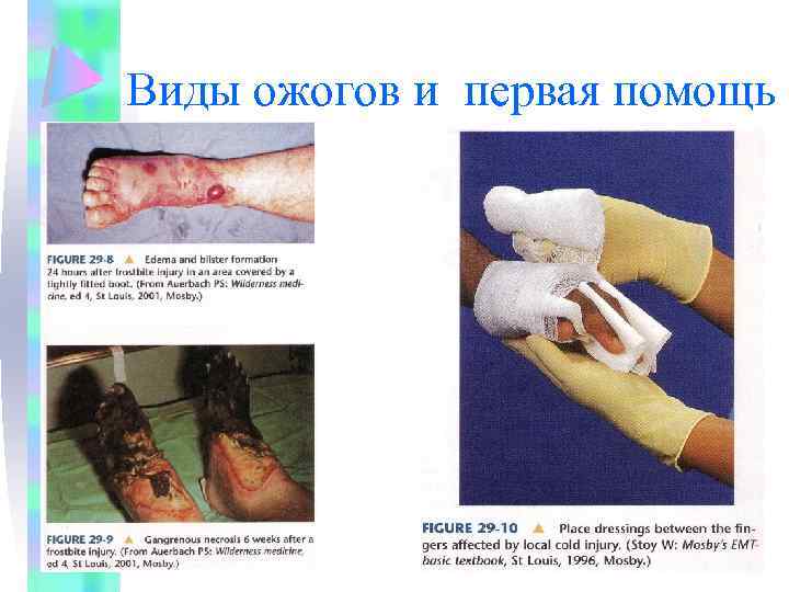 Виды ожогов и первая помощь 