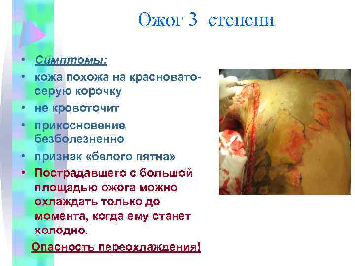 Ожог 3 степени • Симптомы: • кожа похожа на красноватосерую корочку • не кровоточит