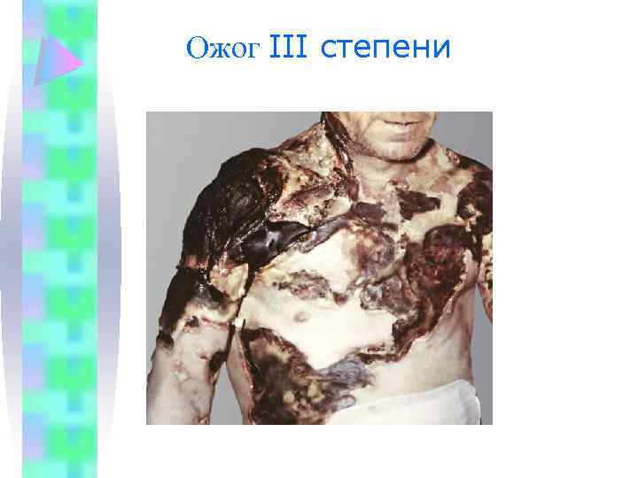 Ожог III степени 