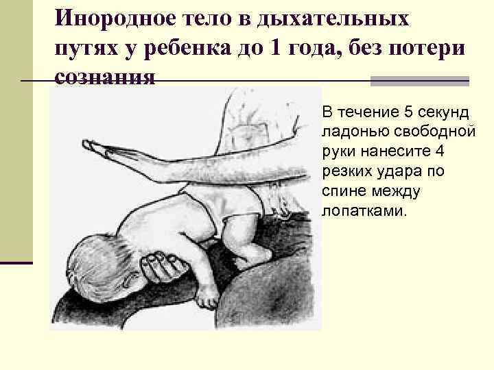 Инородное тело в дыхательных путях у ребенка до 1 года, без потери сознания В
