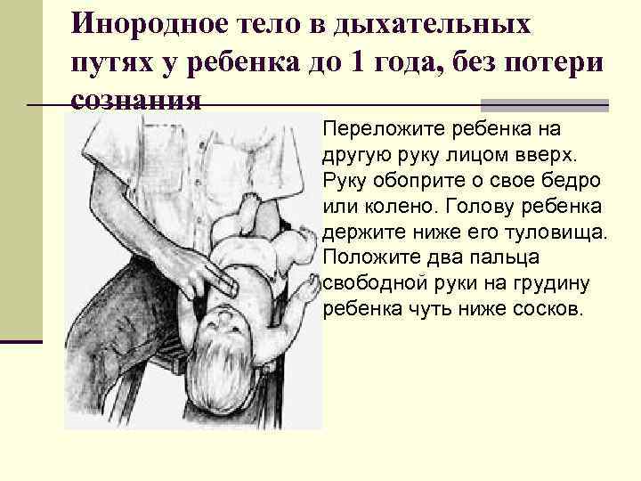 Инородное тело в дыхательных путях у ребенка до 1 года, без потери сознания Переложите