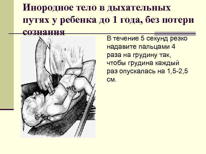 Инородное тело в дыхательных путях у ребенка до 1 года, без потери сознания В