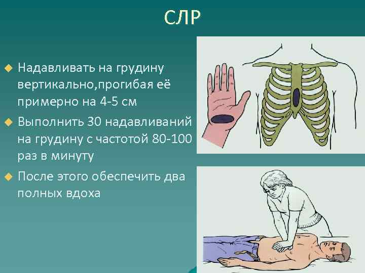 СЛР Надавливать на грудину вертикально, прогибая её примерно на 4 -5 см u Выполнить