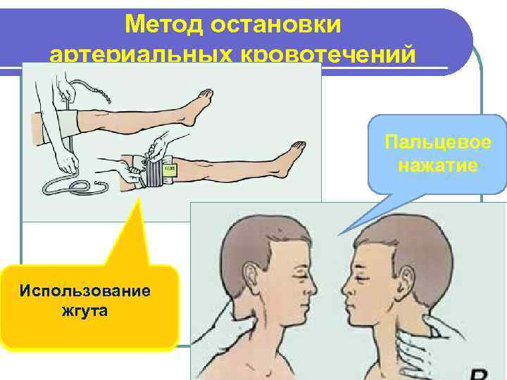 Метод остановки артериальных кровотечений Пальцевое нажатие Использование жгута 