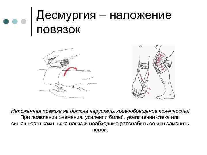 Десмургия – наложение повязок Наложенная повязка не должна нарушать кровообращение конечности! При появлении онемения,
