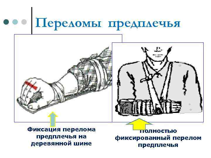 Мкб 10 перелом предплечья кости