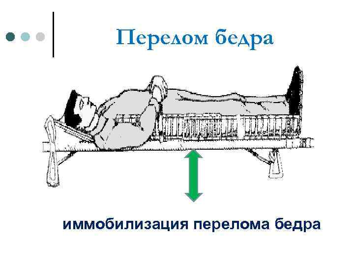 Перелом бедра иммобилизация перелома бедра 