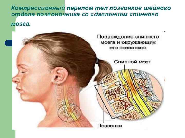 Перелом шейного позвонка