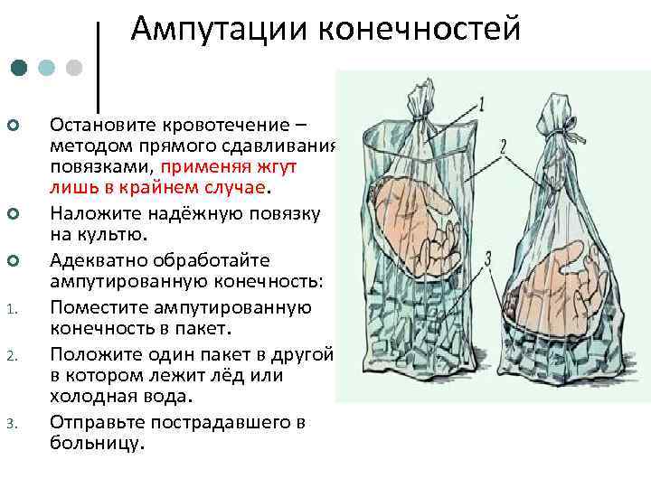 Ампутации конечностей ¢ ¢ ¢ 1. 2. 3. Остановите кровотечение – методом прямого сдавливания