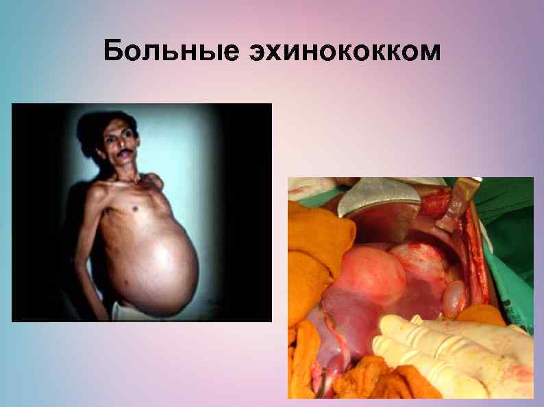 Больные эхинококком 