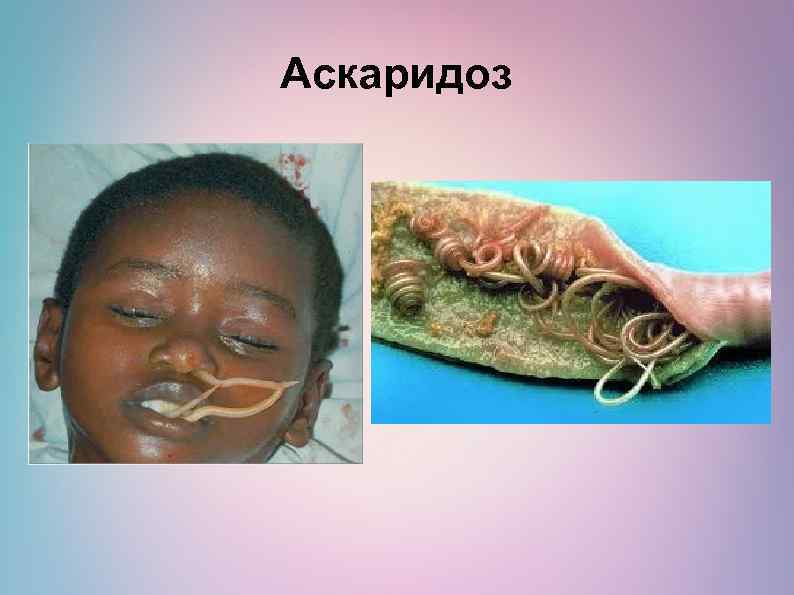 Аскаридоз 