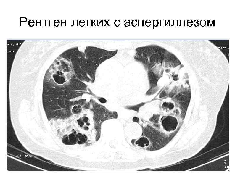 Аспергиллез легких презентация