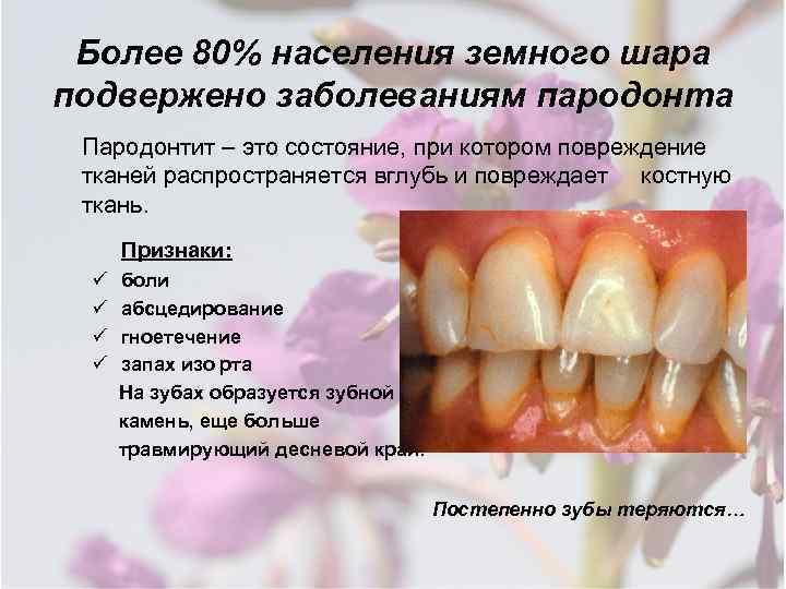 Более 80% населения земного шара подвержено заболеваниям пародонта Пародонтит – это состояние, при котором