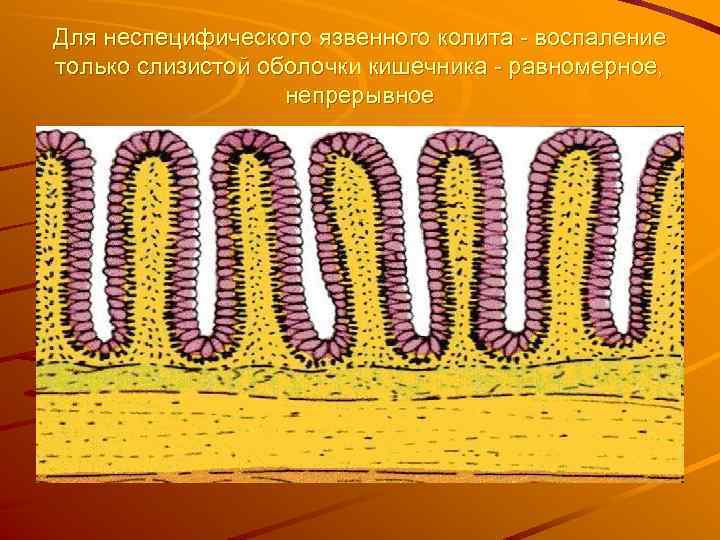 Для неспецифического язвенного колита - воспаление только слизистой оболочки кишечника - равномерное, непрерывное 