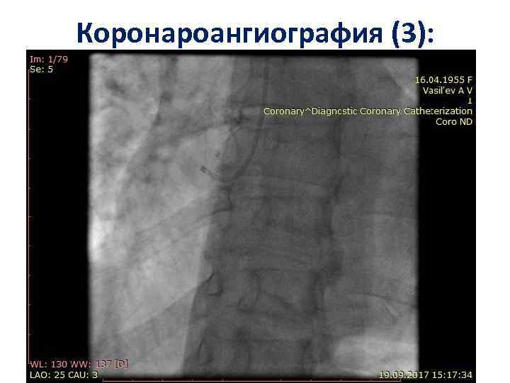 Коронароангиография (3): 