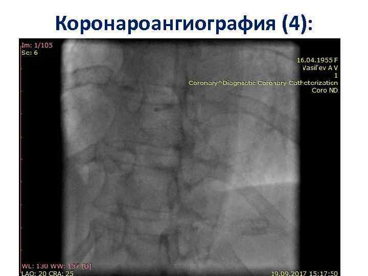 Коронароангиография (4): 