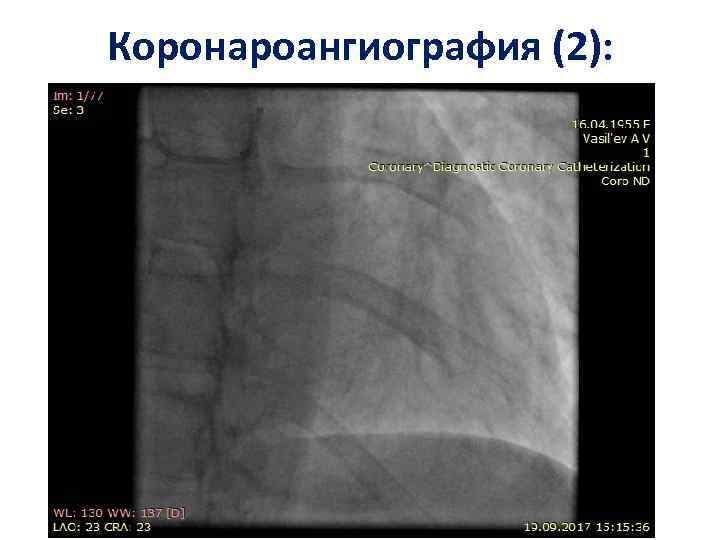 Коронароангиография (2): 