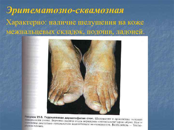 Эритематозно-сквамозная Характерно: наличие шелушения на коже межпальцевых складок, подошв, ладоней. 