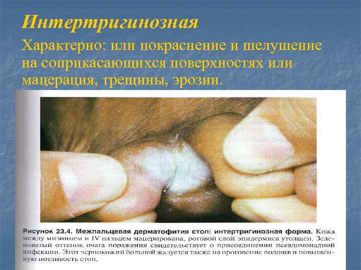 Интертригинозная Характерно: или покраснение и шелушение на соприкасающихся поверхностях или мацерация, трещины, эрозии. 