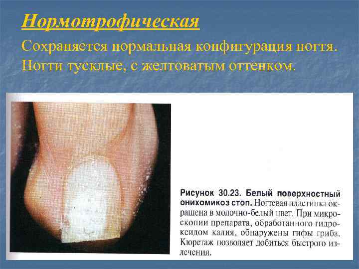 Нормотрофическая Сохраняется нормальная конфигурация ногтя. Ногти тусклые, с желтоватым оттенком. 