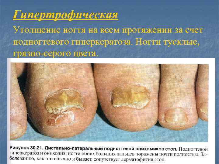Гипертрофическая Утолщение ногтя на всем протяжении за счет подногтевого гиперкератоза. Ногти тусклые, грязно-серого цвета.