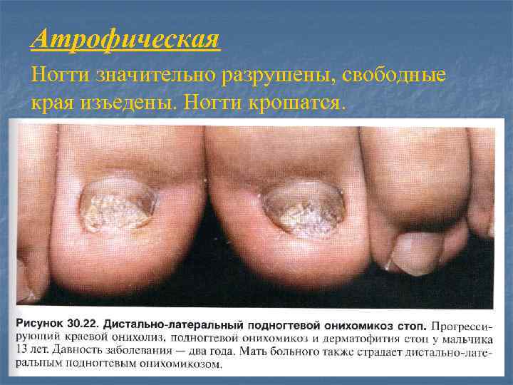Атрофическая Ногти значительно разрушены, свободные края изъедены. Ногти крошатся. 