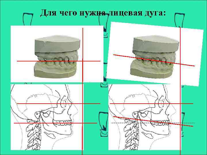 Для чего нужна лицевая дуга: 