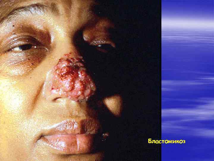 Бластомикоз 