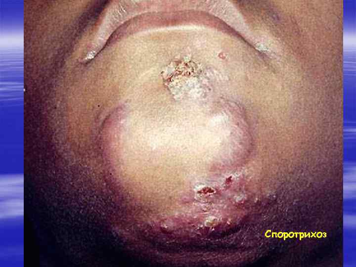 Споротрихоз 