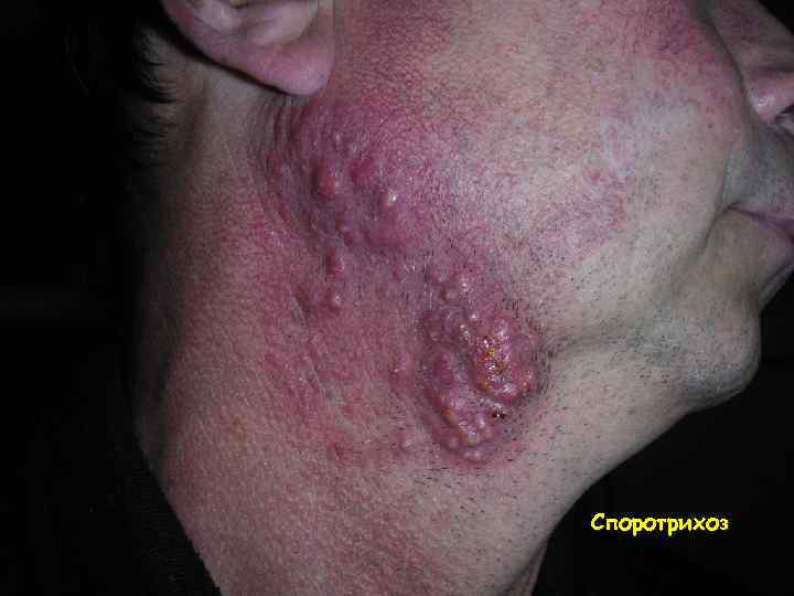 Споротрихоз 