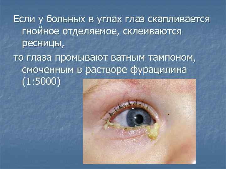 Если у больных в углах глаз скапливается гнойное отделяемое, склеиваются ресницы, то глаза промывают