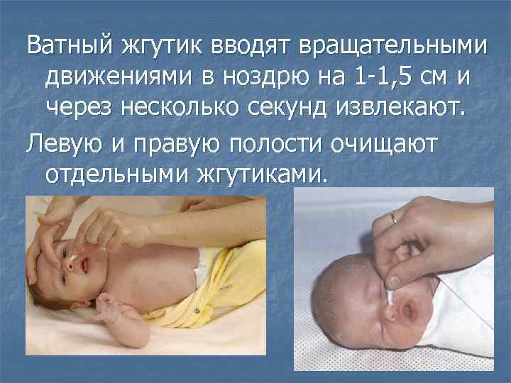 Ватный жгутик вводят вращательными движениями в ноздрю на 1 -1, 5 см и через