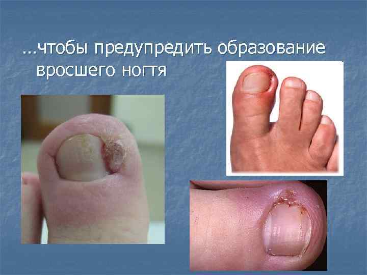 …чтобы предупредить образование вросшего ногтя 