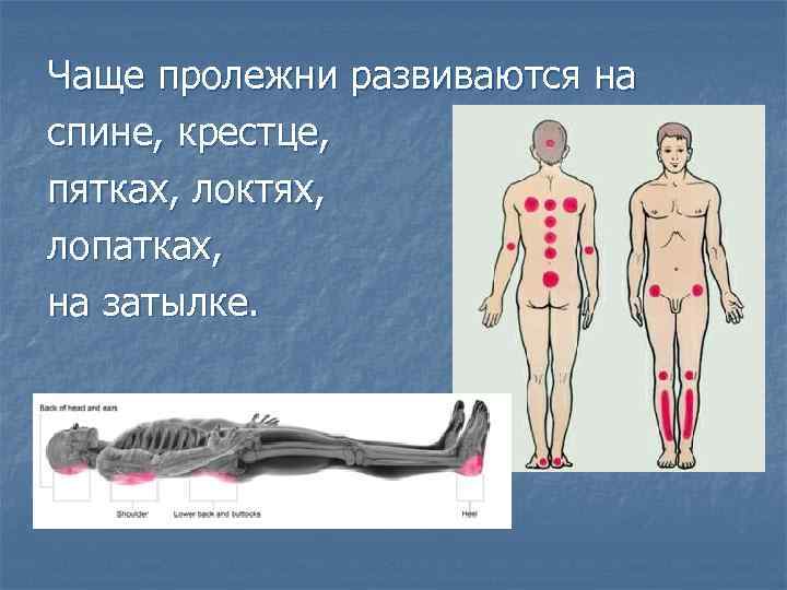 Чаще пролежни развиваются на спине, крестце, пятках, локтях, лопатках, на затылке. 