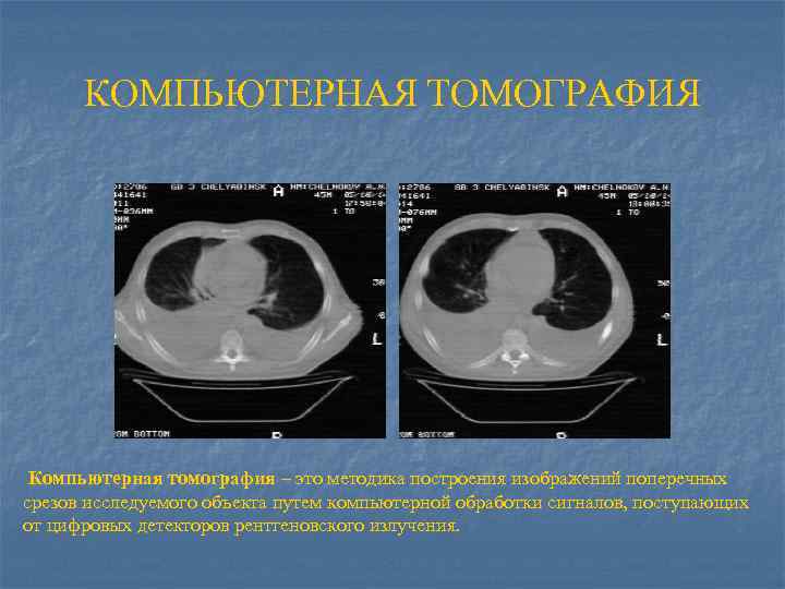 КОМПЬЮТЕРНАЯ ТОМОГРАФИЯ Компьютерная томография – это методика построения изображений поперечных срезов исследуемого объекта путем