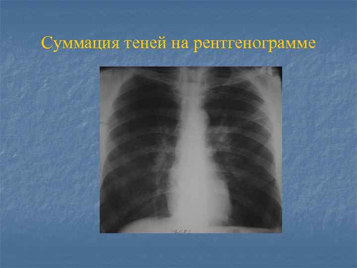 Суммация теней на рентгенограмме 
