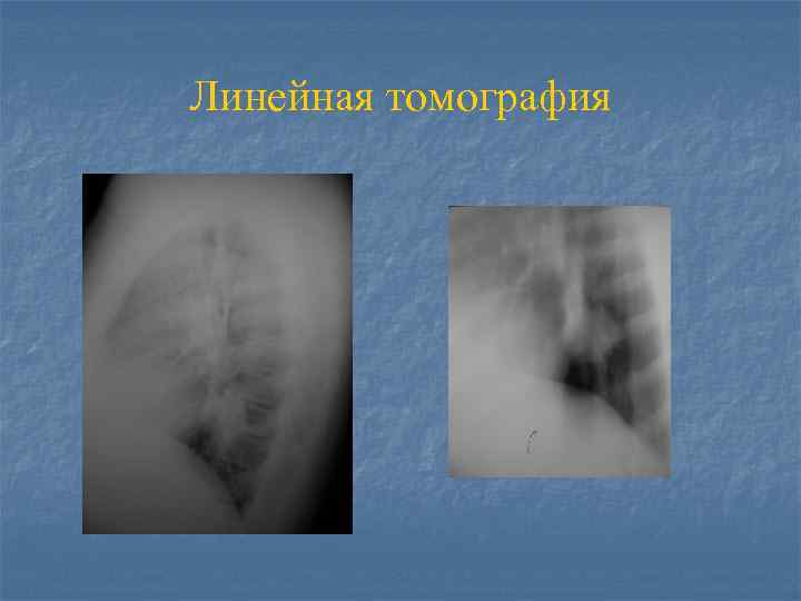 Линейная томография 