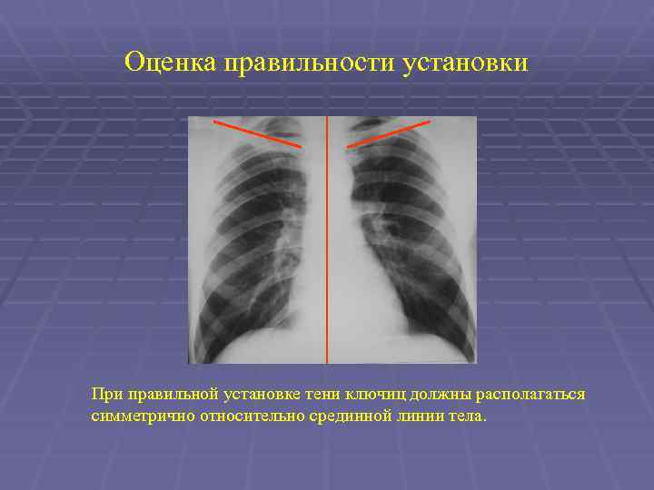 Оценка правильности установки При правильной установке тени ключиц должны располагаться симметрично относительно срединной линии