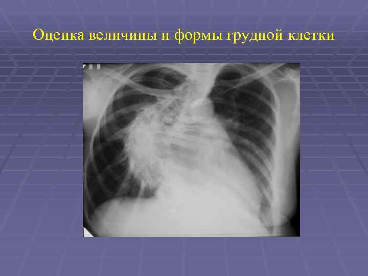 Оценка величины и формы грудной клетки 