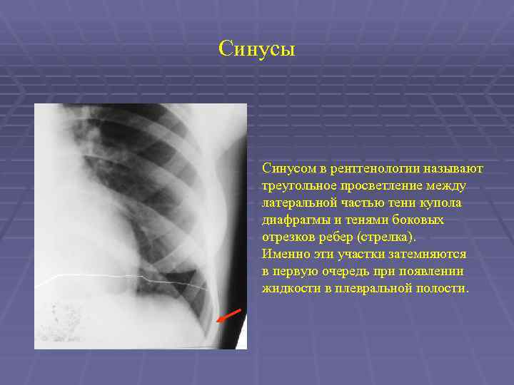 Синусы Синусом в рентгенологии называют треугольное просветление между латеральной частью тени купола диафрагмы и
