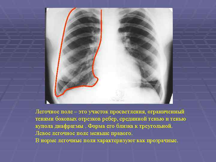 Легочное поле – это участок просветления, ограниченный тенями боковых отрезков ребер, срединной тенью и