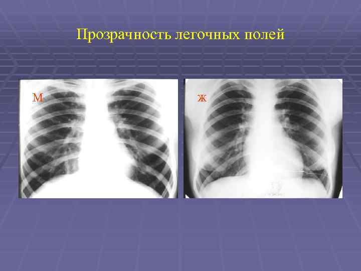 Поля легких. Прозрачность легочных полей. Повышение прозрачности легочных полей. Повышенная прозрачность легочных полей на рентгенограмме. Прозрачность легочных полей на рентгене.