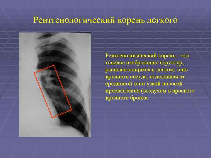 Рентгенологический корень легкого Рентгенологический корень – это теневое изображение структур, располагающихся в легком: тень