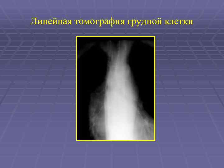 Линейная томография грудной клетки 