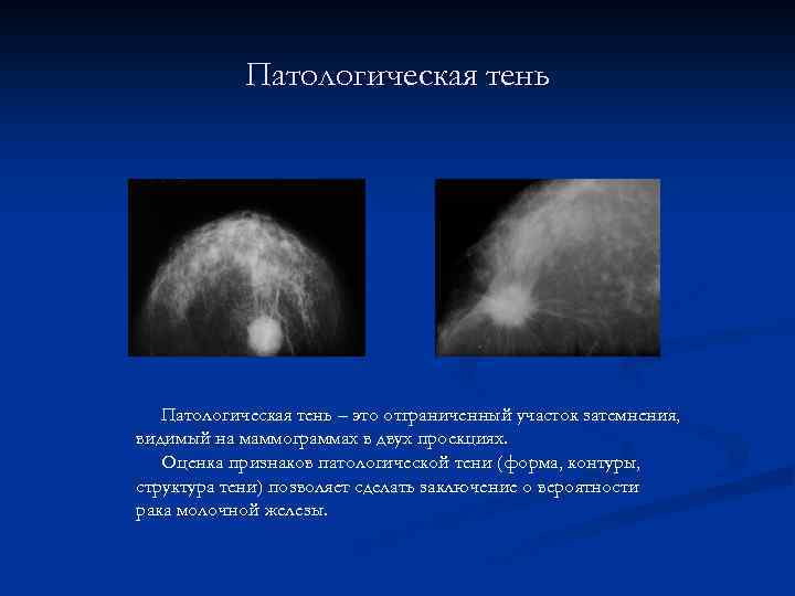 Патологическая тень – это отграниченный участок затемнения, видимый на маммограммах в двух проекциях. Оценка