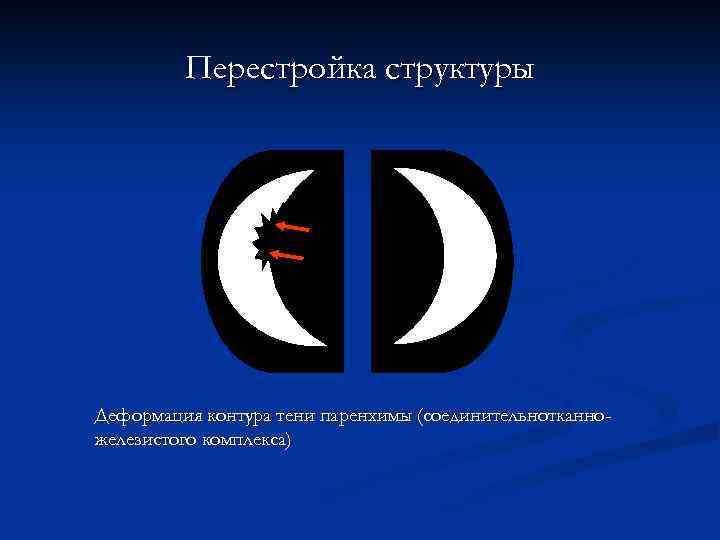 Перестройка структуры Деформация контура тени паренхимы (соединительнотканножелезистого комплекса) 